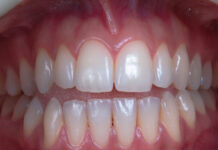 Lupakan Tusuk Gigi, Ini 5 Cara Modern Atasi Sisa Daging Nyangkut di Gigi