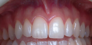 Lupakan Tusuk Gigi, Ini 5 Cara Modern Atasi Sisa Daging Nyangkut di Gigi